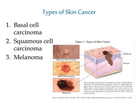 PPT - Skin Cancer PowerPoint Presentation, free download - ID:1861868