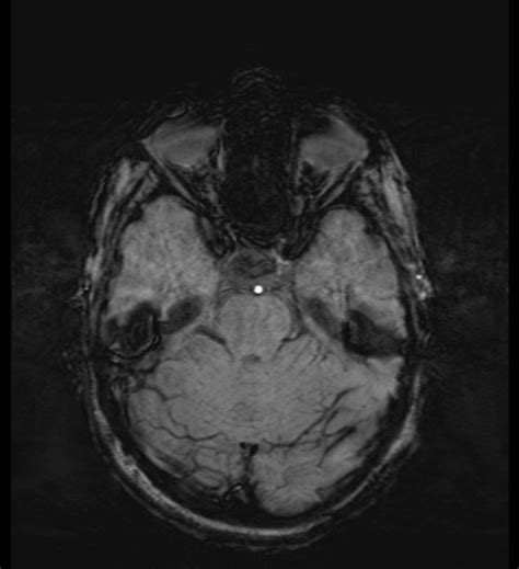 Choroid Plexus Xanthogranuloma Radiopaedia Axial Swi