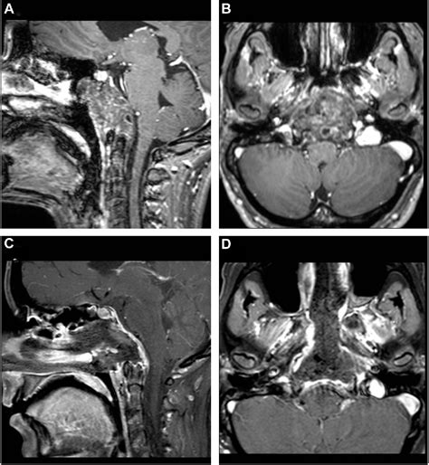 Figure 4 From Extended Endoscopic Endonasal Approach To Clival And