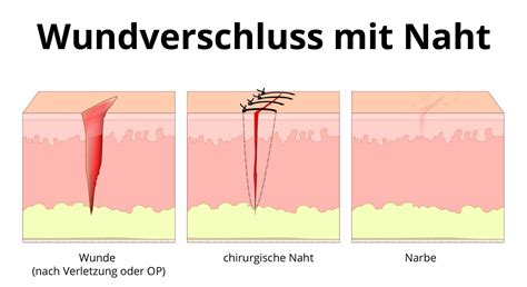 Was Ist Eine Geschlossene Wundbehandlung