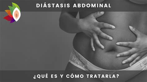 Diástasis abdominal Qué es y cómo tratarla Arantxa Saldise