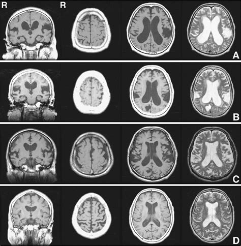 Figure 3 From Guidelines For Management Of Idiopathic Normal Pressure Hydrocephalus Semantic