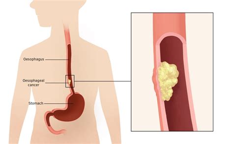 Oesophageal Cancer Dr Tatheds Homeopathy