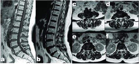 Preoperative Magnetic Resonance Imaging Mri A B T2 And Download Scientific Diagram