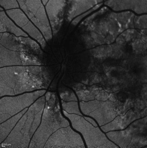 Angioid Streaks Of The Retina