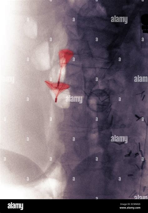 abdomen x-ray showing a vena cava blood clot filter Stock Photo - Alamy