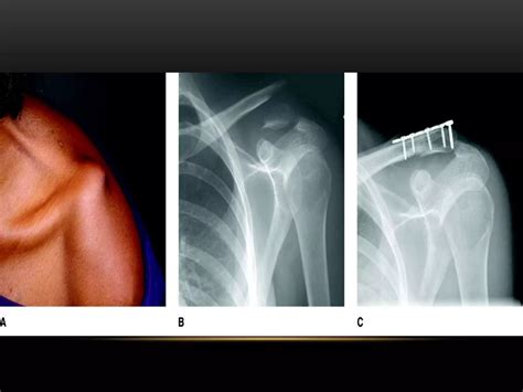 Clavicle fracture | PPTX
