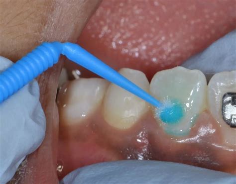 Glass Ionomer Cement Fissure Sealants Useful As Non Aerosol Generating