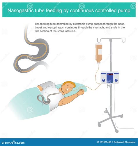 Nasogastric Tube Feeding Procedure