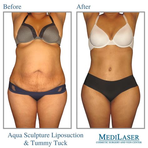 Tummy Tuck And Liposuction Before And After Medilaser Surgery And Vein Center