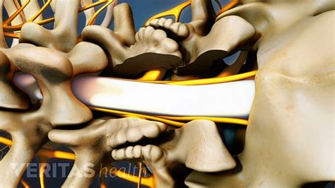 A Visual Guide To Lumbar Laminectomy Surgery