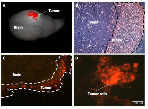Brain Metastasis Of RFP T In Nude Mice After Orthotopic Implantation