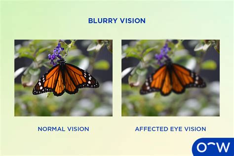 Distorted Vision Metamorphopsia Definition Types And Causes