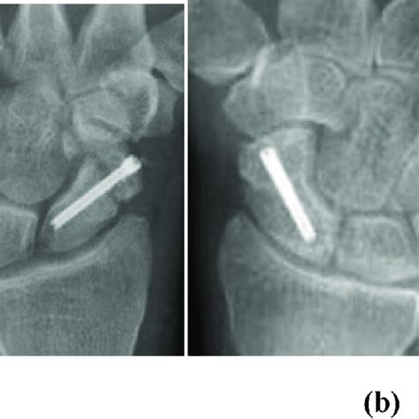 A Preoperative Pa Wrist X Ray Of Non United Scaphoid Fracture After Download Scientific