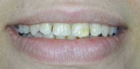 Press On Veneers Before and After - Photo Gallery – TruSmile Veneers