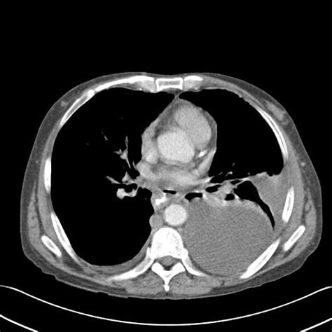 Esophageal Perforation Image Radiopaedia Org