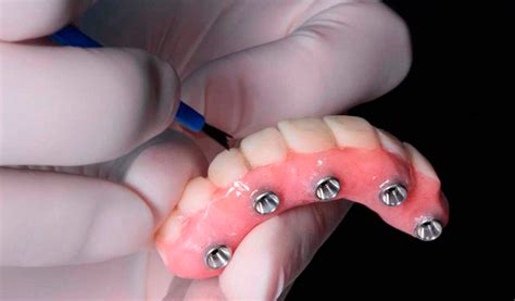 Permanent Dentures Vs Dental Implants A Brief Comparison