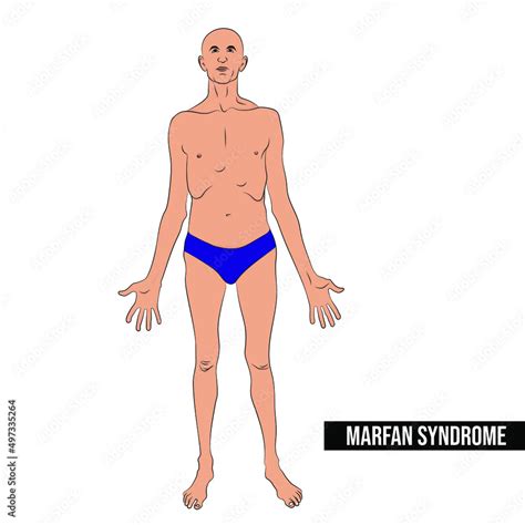 People With Marfan Syndrome Are Tall And Thin And Have Long Arms Legs