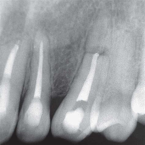 Pdf Horizontal Root Fracture A Case Report