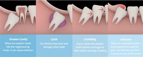 Wisdom Tooth Extraction/Removal in Bangkok, Thailand