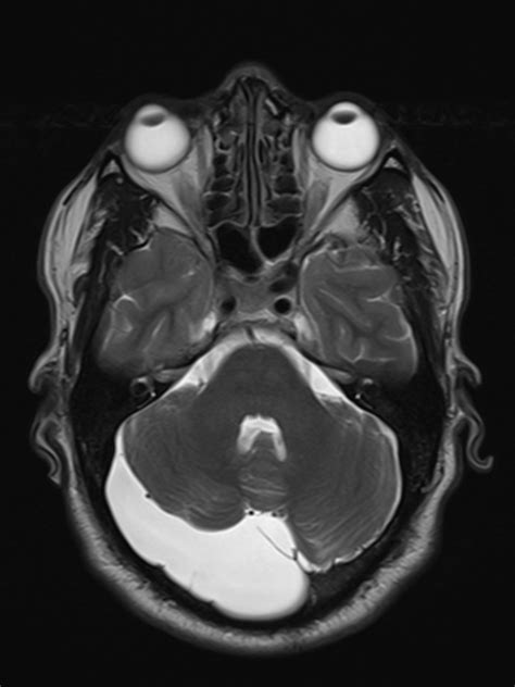 Retro Cerebellar Arachnoid Cyst Image