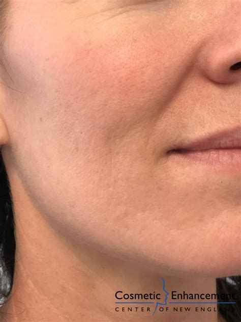 Pixel Microneedling Rf Before After Gallery