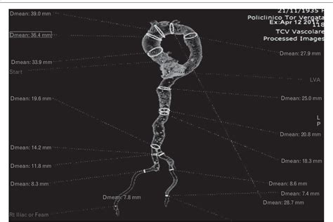 Figure 1 From The Role Of Computed Tomography In The Planning Of