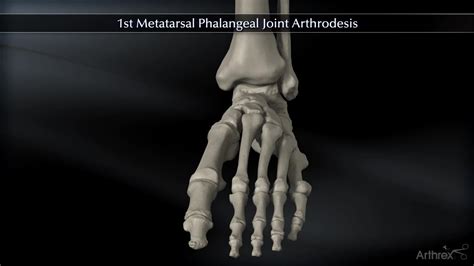 Metatarsal Phalangeal Joint Anatomy Hot Sex Picture