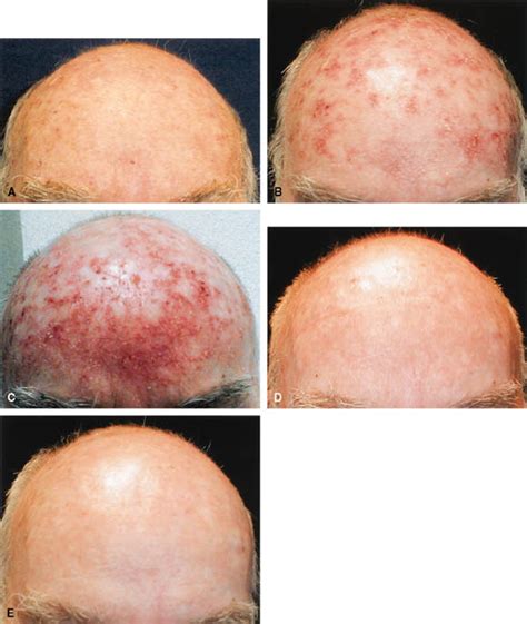 Cycle Therapy Of Actinic Keratoses Of The Face And Scalp With 5