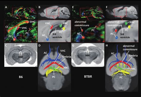 Diffusion Tensor Imaging DTI And Diffusion Tensor Tractography DTT