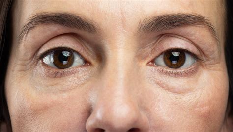 Under Eye Bags What You Need To Know