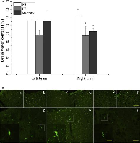 Figure 1 From Bolus Injection Of Hypertonic Solutions For Cerebral