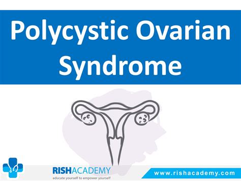 Polycystic Ovarian Syndrome Rish Academy