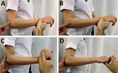 Radial tunnel syndrome causes, symptoms, diagnosis & treatment