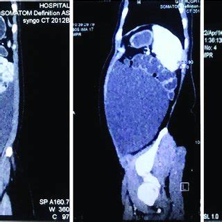 Contrast Enhanced Computed Tomography Scan Displays A Well Defined