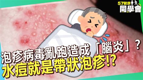 泡疹病毒亂跑造成腦炎 水痘就是帶狀泡疹 57healthy 洪永祥 醫師 YouTube