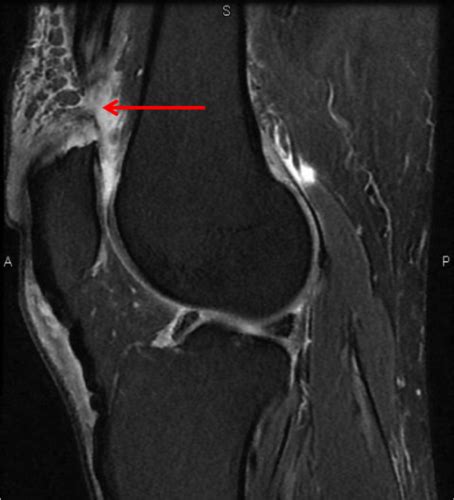 Med Imaging Quiz 2 Knee Imaging Flashcards Quizlet