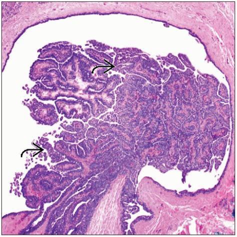 Papilloma Large Duct And Small Duct Basicmedical Key