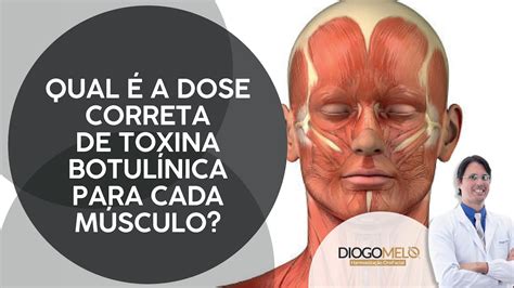 Qual é A Dose Correta De Toxina Botulínica Para Cada Músculo Youtube