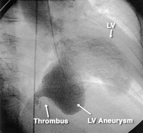 Massive Left Ventricular Aneurysm Circulation