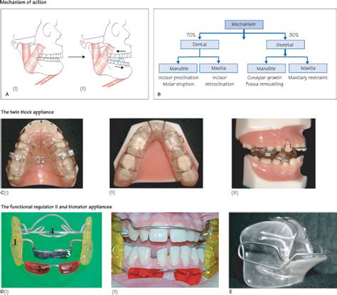 39 Functional Appliances Pocket Dentistry