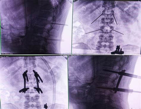 How Does The Intelligent Spinal Navigation Robot Accomplish Fracture