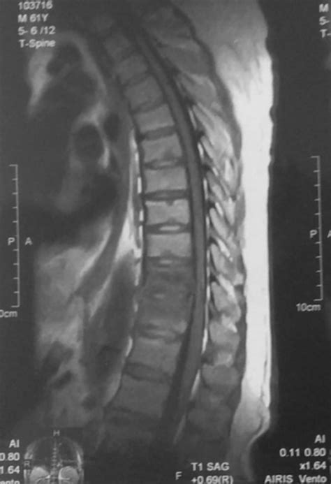 Pre Operative Mri T1 A And T2 B And Post Operative Sagittal Ct Scan Download Scientific Diagram