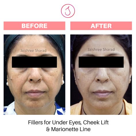 Liquid Face Lift – DR. JAISHREE SHARAD