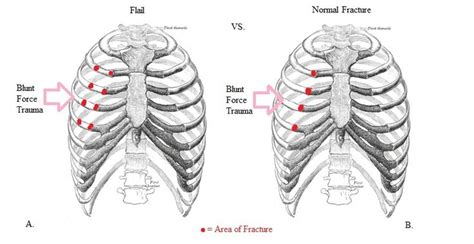 What Is Flail Chest Flail Chest Chest Medical Knowledge