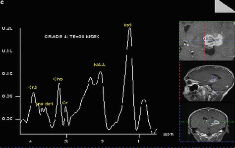 Magnetic Resonance Spectroscopy Imaging