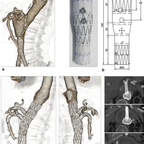 A A 58 Year Old Woman Case 2 Was Admitted For An Asymptomatic Download Scientific Diagram