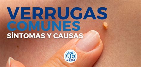 Verrugas Comunes S Ntomas Y Causas Gesmedi