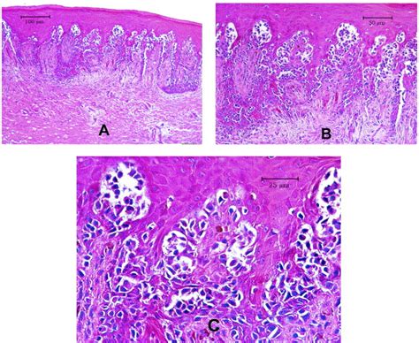 Intraoral Melanoma Long Term Follow Up And Implication For Dental