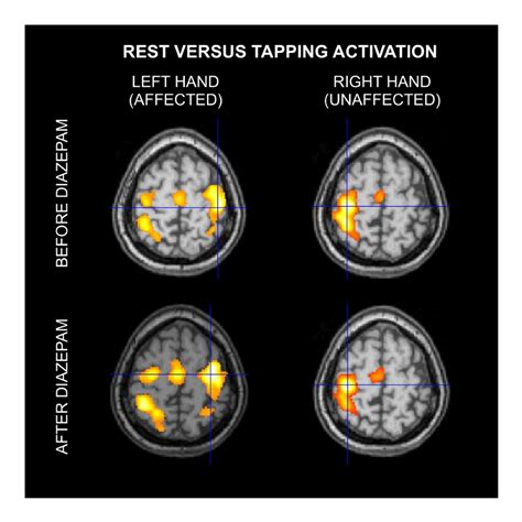 Fmri Scans Brain